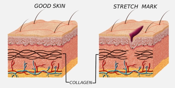 rạn da hình thành như thế nào